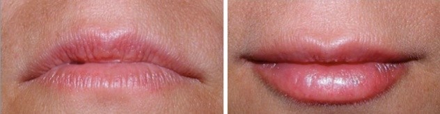 Juvederm Treatments