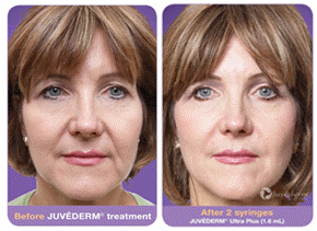 Juvederm Treatments